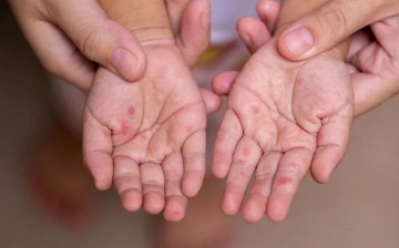 Число случаев заболевания корью в Европе и ЦА выросло более чем на 3 000%