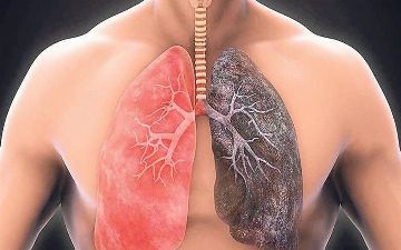 Могут ли заболевания легких передаваться по наследству: объясняет врач