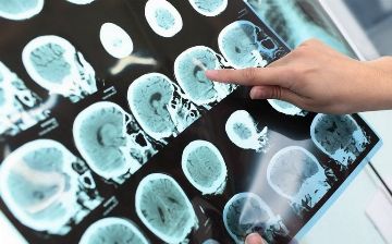 Разработан препарат от болезни Альцгеймера