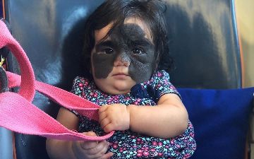 Врачи удалили девочке «маску Бэтмена» с лица. Посмотрите, как она сейчас выглядит — фото