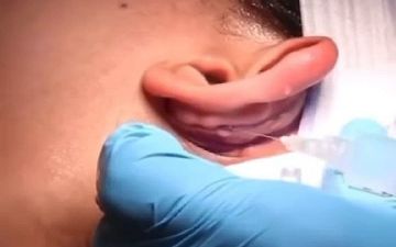 Отопластика: как проходит операция по коррекции лопоухости – видео