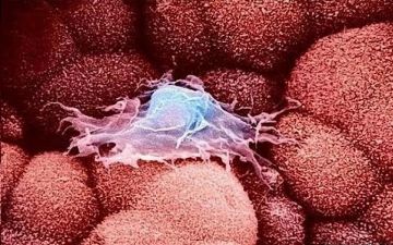 Названы первые симптомы раковой опухоли