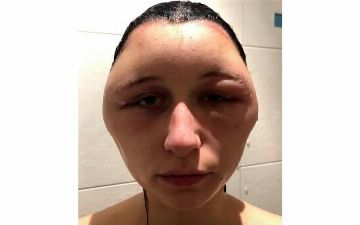 Результат аллергической реакции на популярную у женщин косметическую процедуру — рассказываем, что случилось