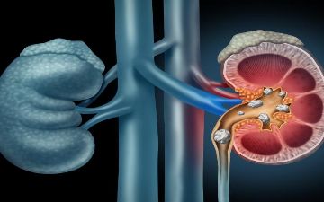 Врач рассказал, как избежать мочекаменной болезни