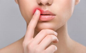 Почему на губах появляется герпес, как его лечить и как не инфицироваться?