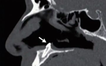 Росший в носу у мужчины зуб долгие годы мешал пациенту дышать — подробности