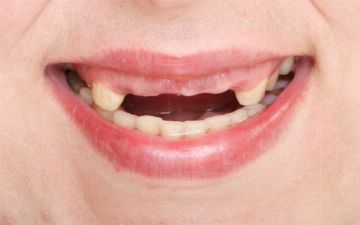 При диабете выпадают зубы — как еще выявить признаки диабета?