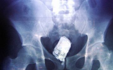 Мужчина проглотил телефон и полгода проходил с ним в животе