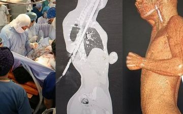 В Ташкенте подросток чудом выжил после того, как его проткнуло арматурой