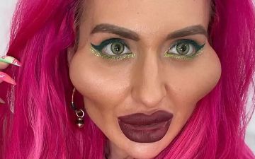 Модель с аномально большими щеками показала, как она выглядела до пластических операций
