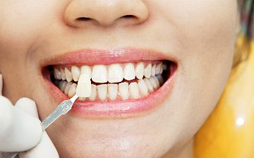 Виниры: что такое и стоит ли их устанавливать