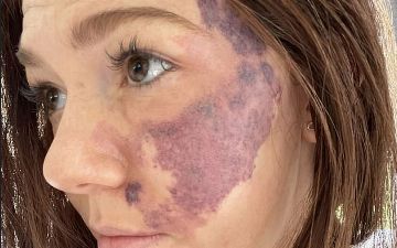 Девушка пять лет скрывала от жениха родимое пятно на пол-лица, замазывая его «тоналкой»