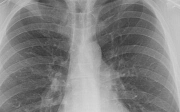 В Узбекистане еще один человек умер от пневмонии — статистика