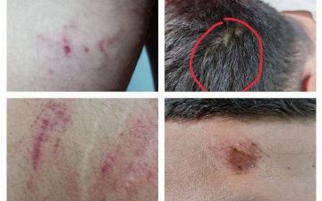 Журналисты телеканала Sevimli пожаловались, что их жестоко избили сотрудники ОВД