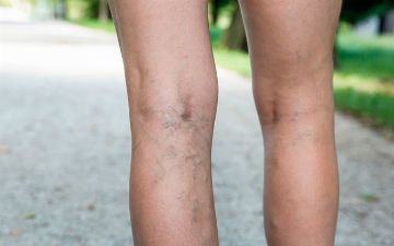 Узбекский терапевт рассказала, почему мази не работают при варикозе