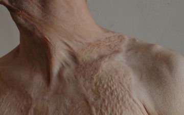 Учёные обнаружили препарат, заживляющий раны без шрамов