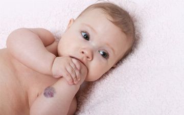 Гемангиома у новорожденных: причина и лечение