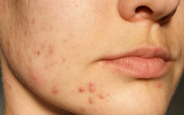 Какие продукты вредны для кожи?