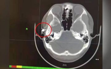 Мужчину мучали постоянные головные боли – оказалось, дело в пуле в его голове