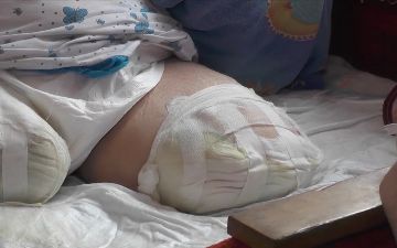 Девятнадцатилетний студент лишился ног до колен после того, как съел лапшу с курицей 