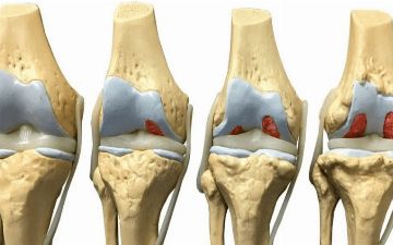 В Сибири начнут лечить суставы с помощью жира
