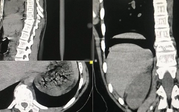 В Ташкенте мужчина избил парня до перелома позвоночника