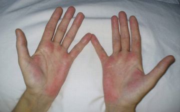 Как определить по коже, что у вас серьезная болезнь печени