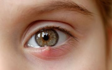 Почему появляется ячмень на глазу