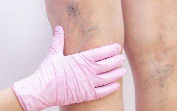 Специалист рассказал, в чем смертельная опасность варикоза