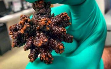 Откуда в организме появляются камни?