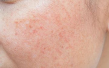 «Лишь бы угодить сыночку». Врача из Ташкента шокировали просьбой свекрови удалить веснушки с лица невестки