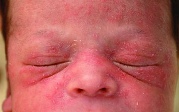 Терапевт из Узбекистана рассказала, откуда берется контагиозный моллюск 