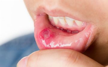 Врач из Узбекистана рассказал, как лечить стоматит