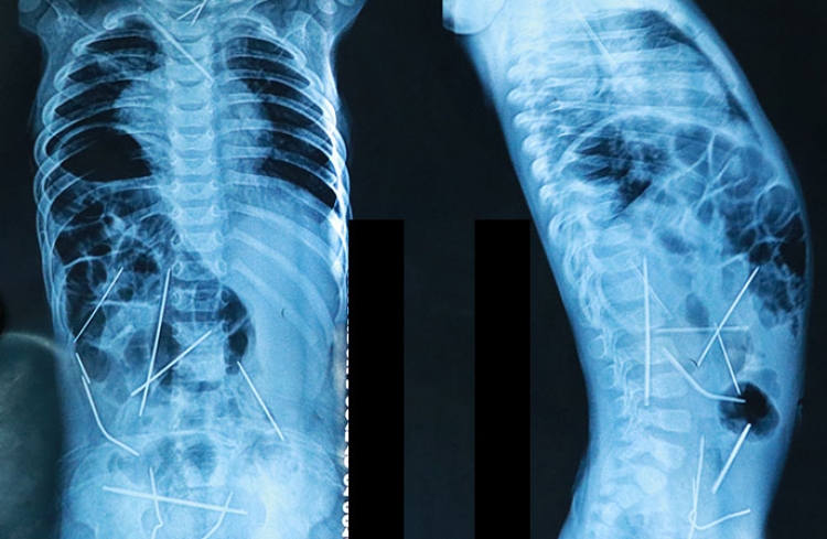 Главврач рассказал о состоянии малыша, в теле которого нашли 16 иголок